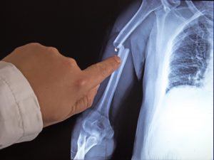 X-ray image of broken arm on monitor of pc. The doctor shows by finger on a broken arm.