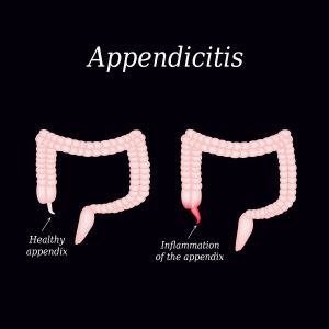 Appendicitis. Inflammation of the appendix. Colon. The illustration on a black background