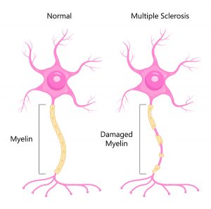 Neuron concept vector. Dendrite, axon, soma of neuron. Multiple sclerosis, nerve anatomy illustration.